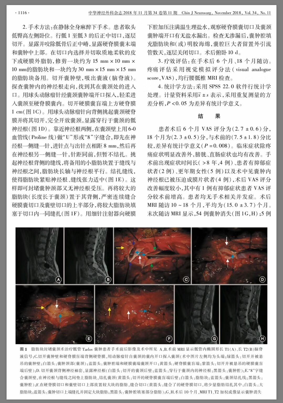 揭秘骶管囊肿最新治疗方法，掌握健康之钥，引领您走向健康生活之路