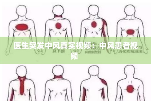 医生突发中风真实视频：中风患者视频 