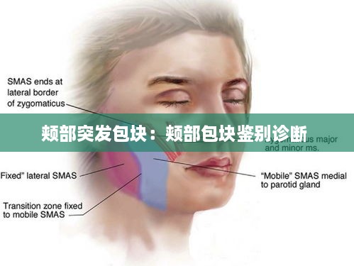 颊部突发包块：颊部包块鉴别诊断 