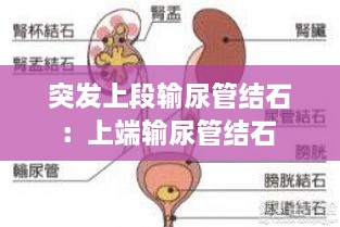 突发上段输尿管结石：上端输尿管结石 