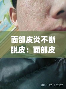 面部皮炎不断脱皮：面部皮炎掉皮 