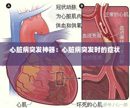 心脏病突发神器：心脏病突发时的症状 